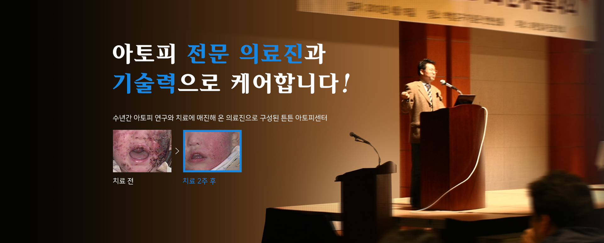 난치성 아토피